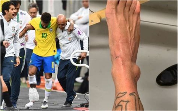 Did Neymar tear his ACL?
